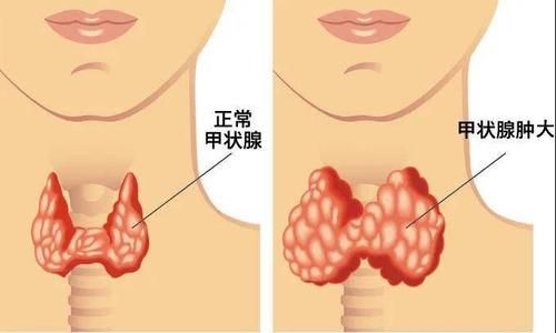 甲状腺多少克（甲状腺多少mm要治疗）-图2